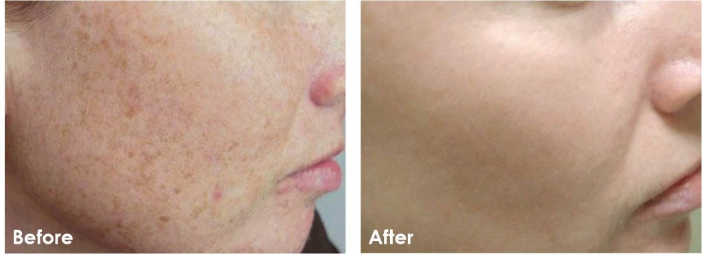 IPL-Photofacial-Before-After-1-1024x371.jpg IPL-Photofacial-Before-After-1-1024x371.jpg